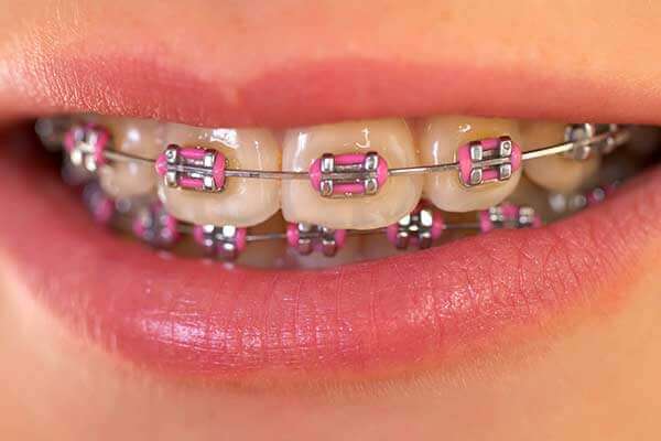 Traditional Braces in New Jersey