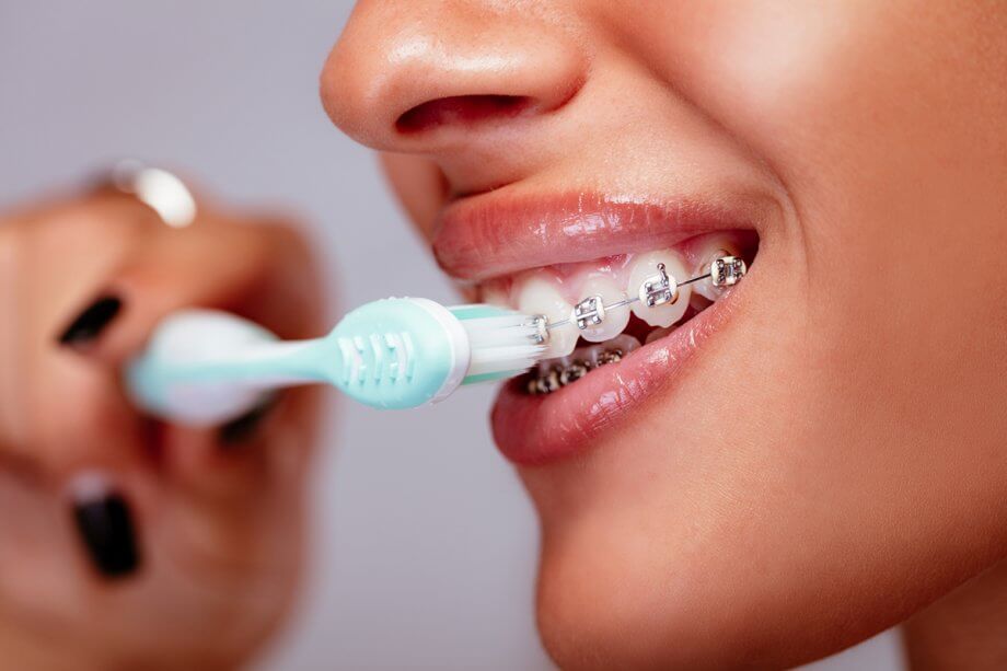 How Do You Brush Your Teeth With Braces?